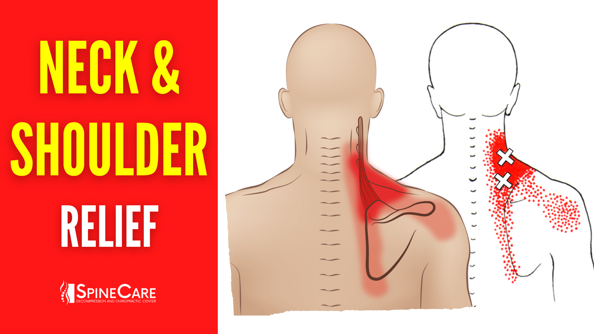 https://www.bestspinecare.com/wp-content/uploads/2022/08/How-to-Fix-Neck-and-Shoulder-Pain-FOR-GOOD.png